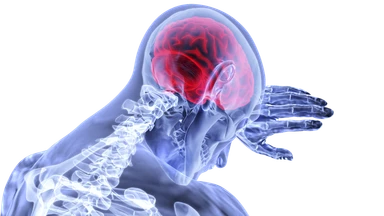 Illustration of Stroke showing brain inflammation